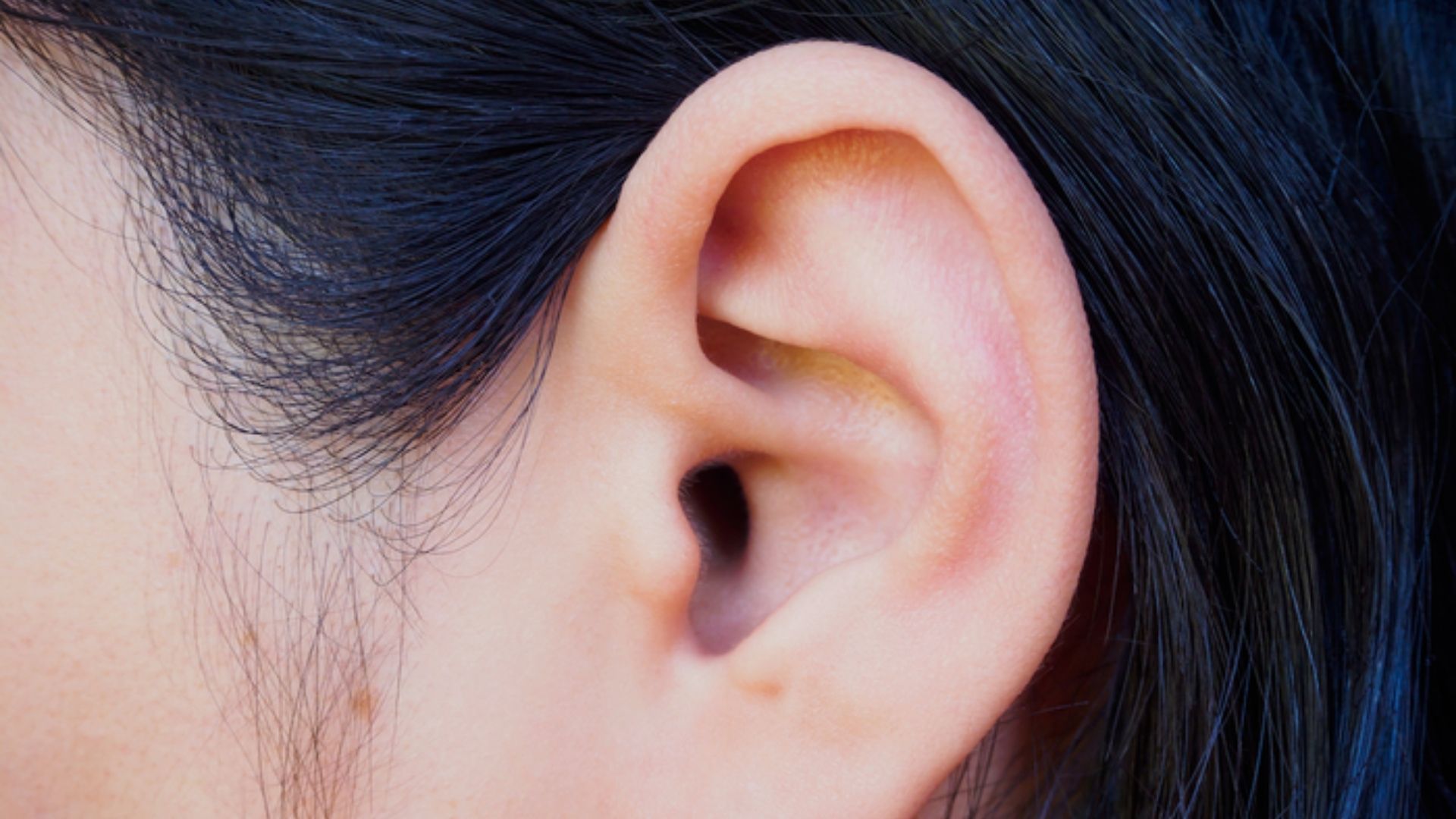 What Is Reverse-Slope Hearing Loss?