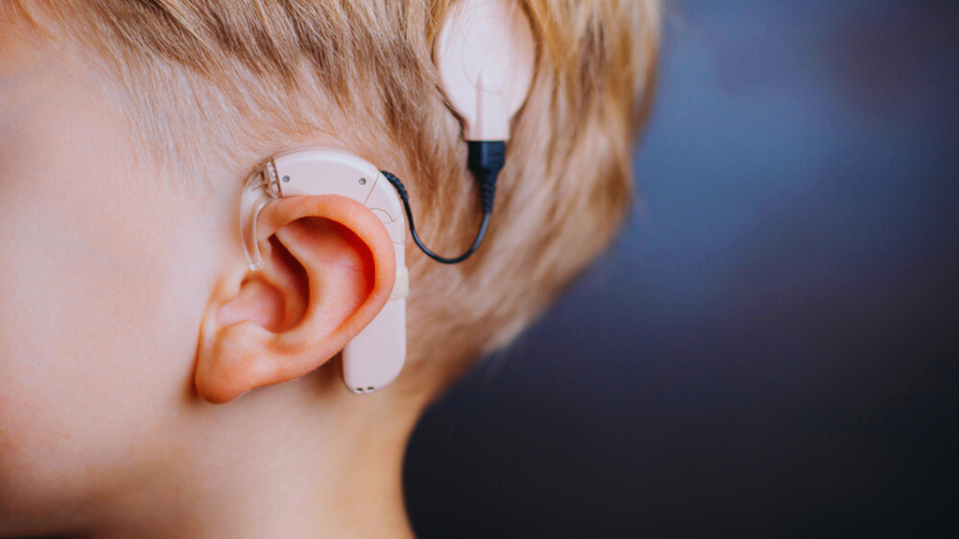 The Transformative Role Of Cochlear Implants In Children Impairments